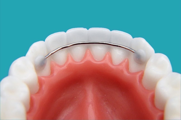 Bonded Retainers in Brevard County