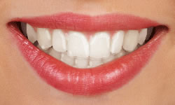 Close up of the mouth of a woman with Invisalign invisible aligners