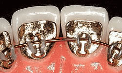 Image of lingual braces against the back of a bottom row of teeth