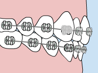 Drawing of a mouth with braces with a gray blob over one of the brackets indicating it's loose