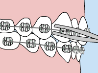 Drawing of a mouth with braces with a pair of orthodontic forceps adjusting a wire