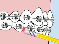 Drawing of a mouth with braces with a pencil eraser adjusting a poking wire