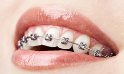 Extreme close up of the smile of a woman wearing self-ligating braces