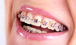 Close up of the smile of a woman with pink metal braces