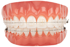 Dental model with concealed clear ceramic braces