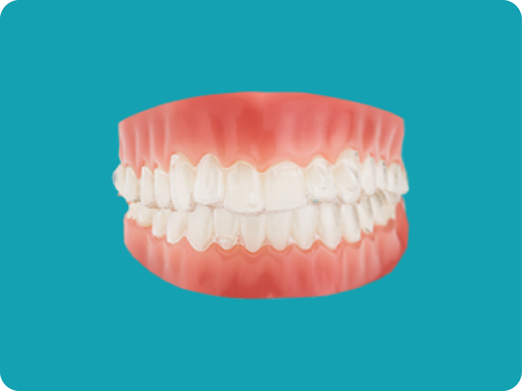 Dental model with invisible Invisalign Clear Aligners.