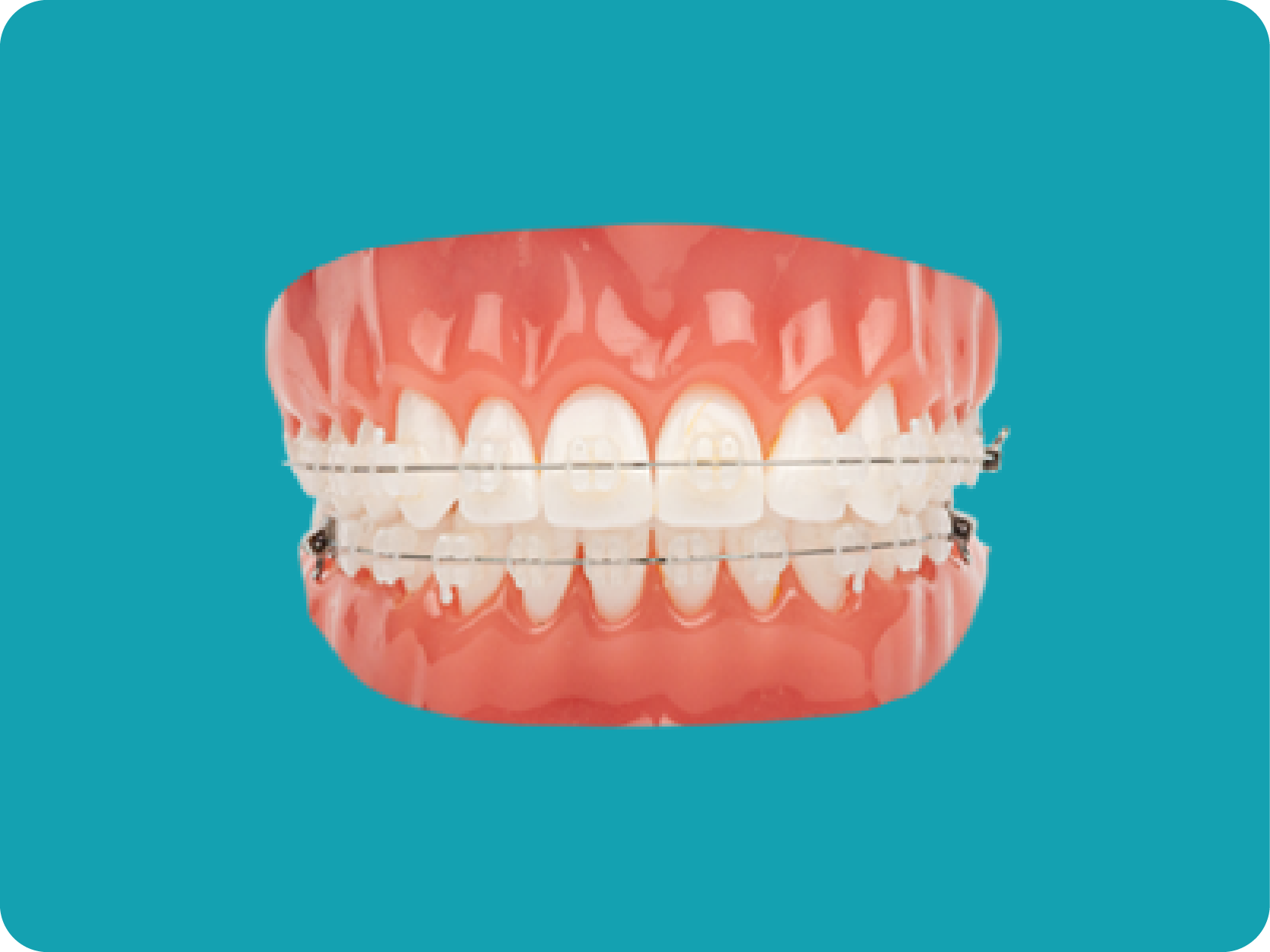 Dental model with concealed clear ceramic braces.