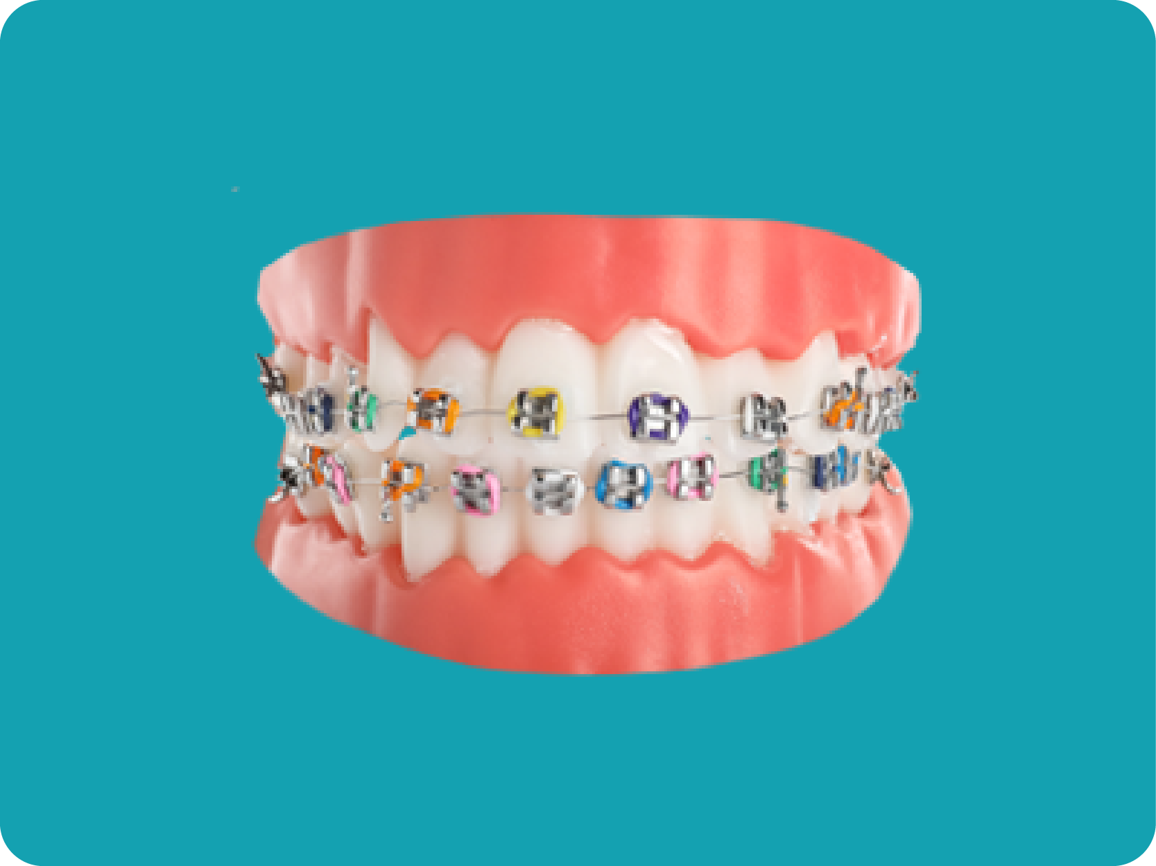 A dental model with traditional metal braces containing brackets of assorted colors.