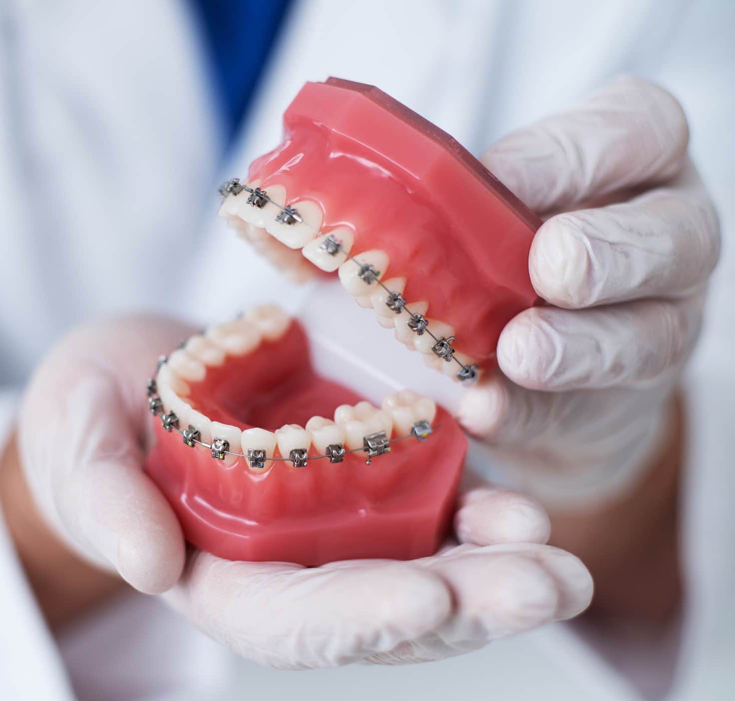 the doctor shows how the system of braces on teeth is arranged.