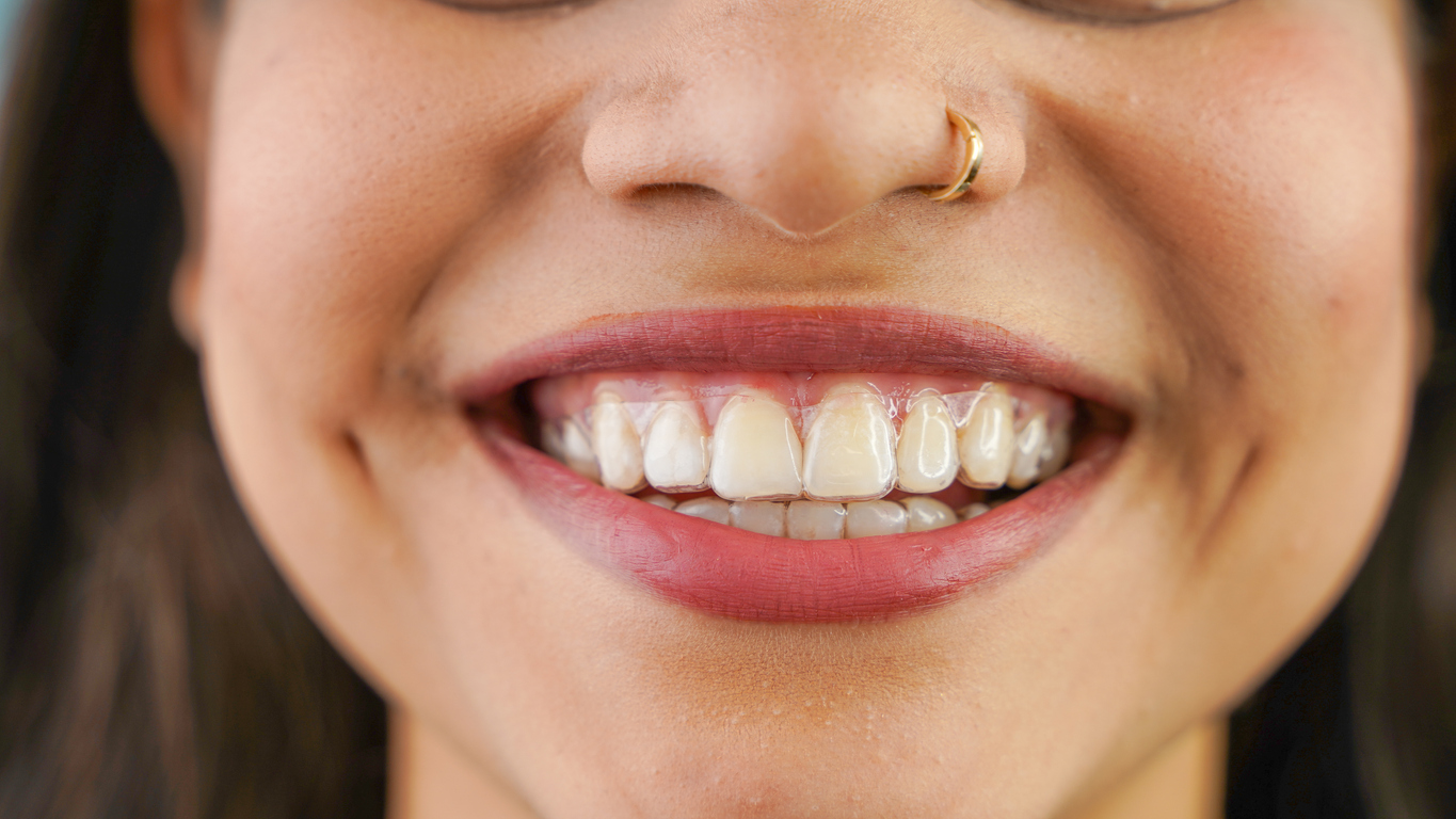 Close up of the smile of a young adult with a clear retainer in Melbourne, FL.