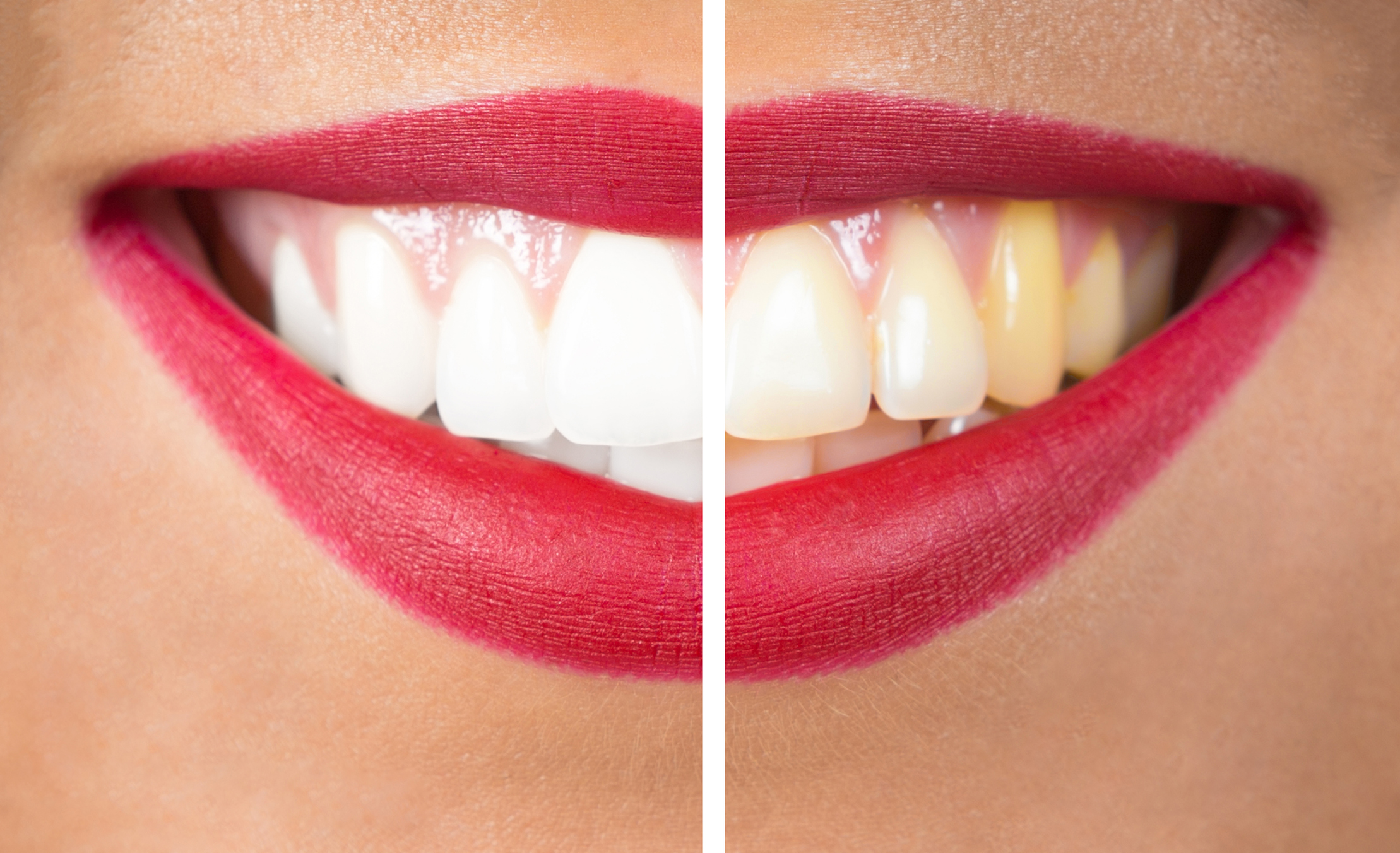 Smile of an adult with a before and after from teeth whitening in Melbourne, FL.