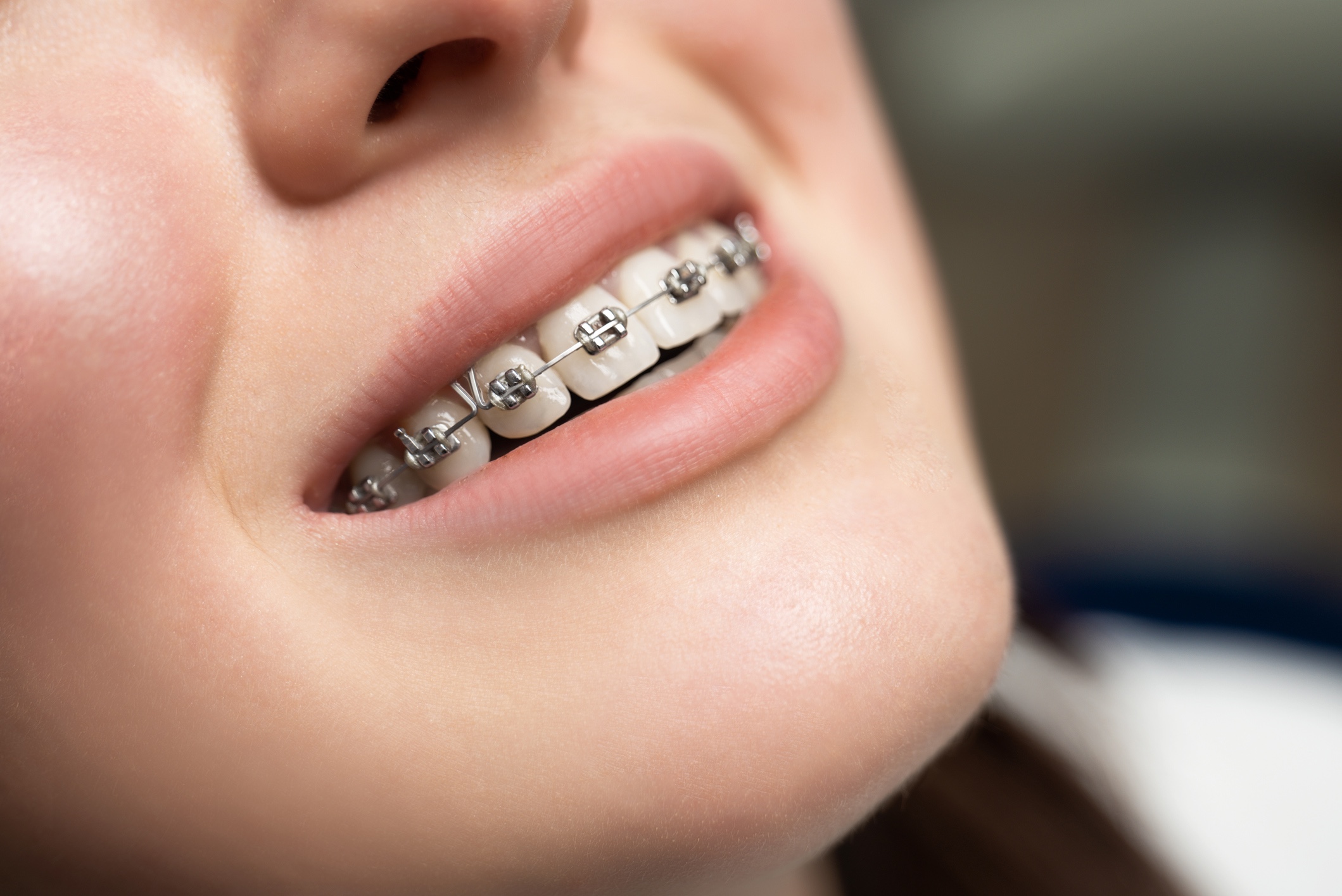 Teen with traditional metal braces in Melbourne, FL smiling at Goff Orthodontics