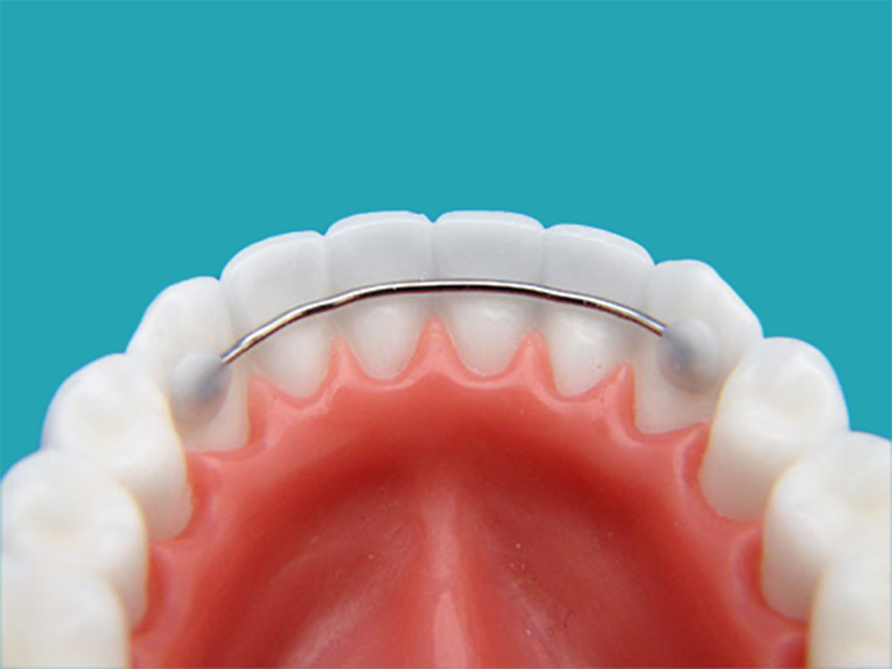 Bonded Retainers in front of a teal background.