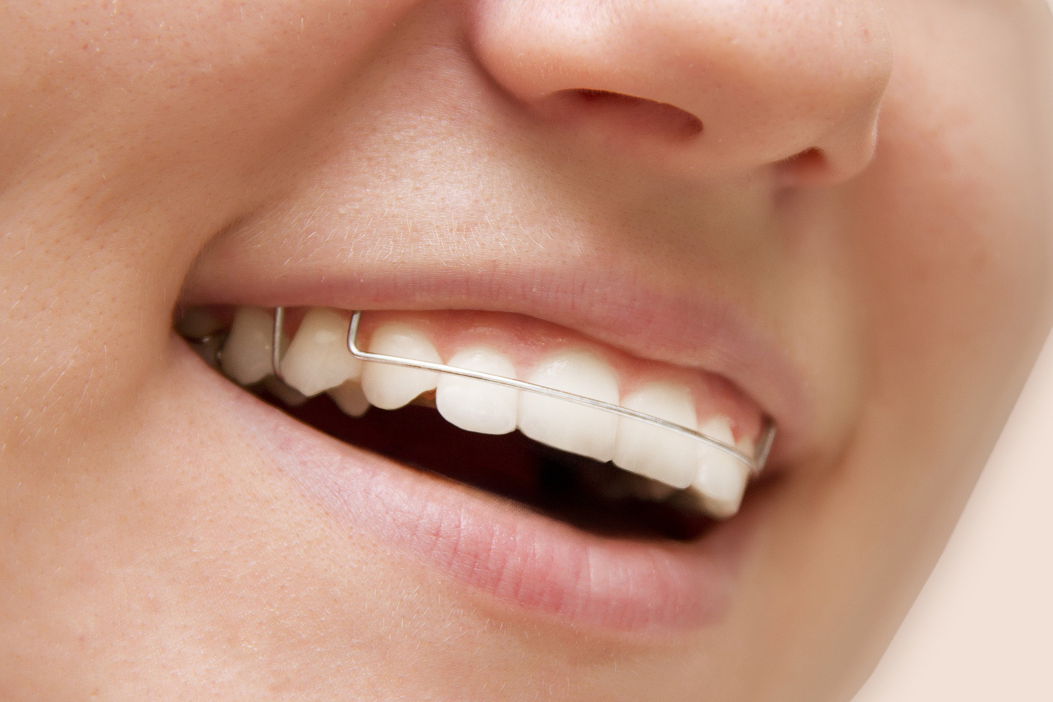 What Is a Retainer and What Does It Do for Your Teeth?